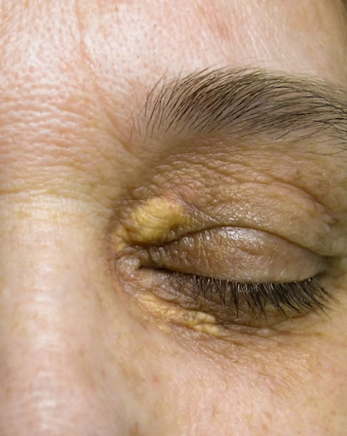 problème yeux, xanthélasma